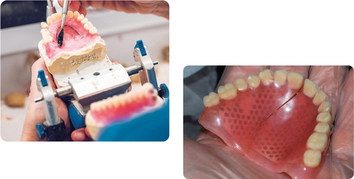 Denture repairs