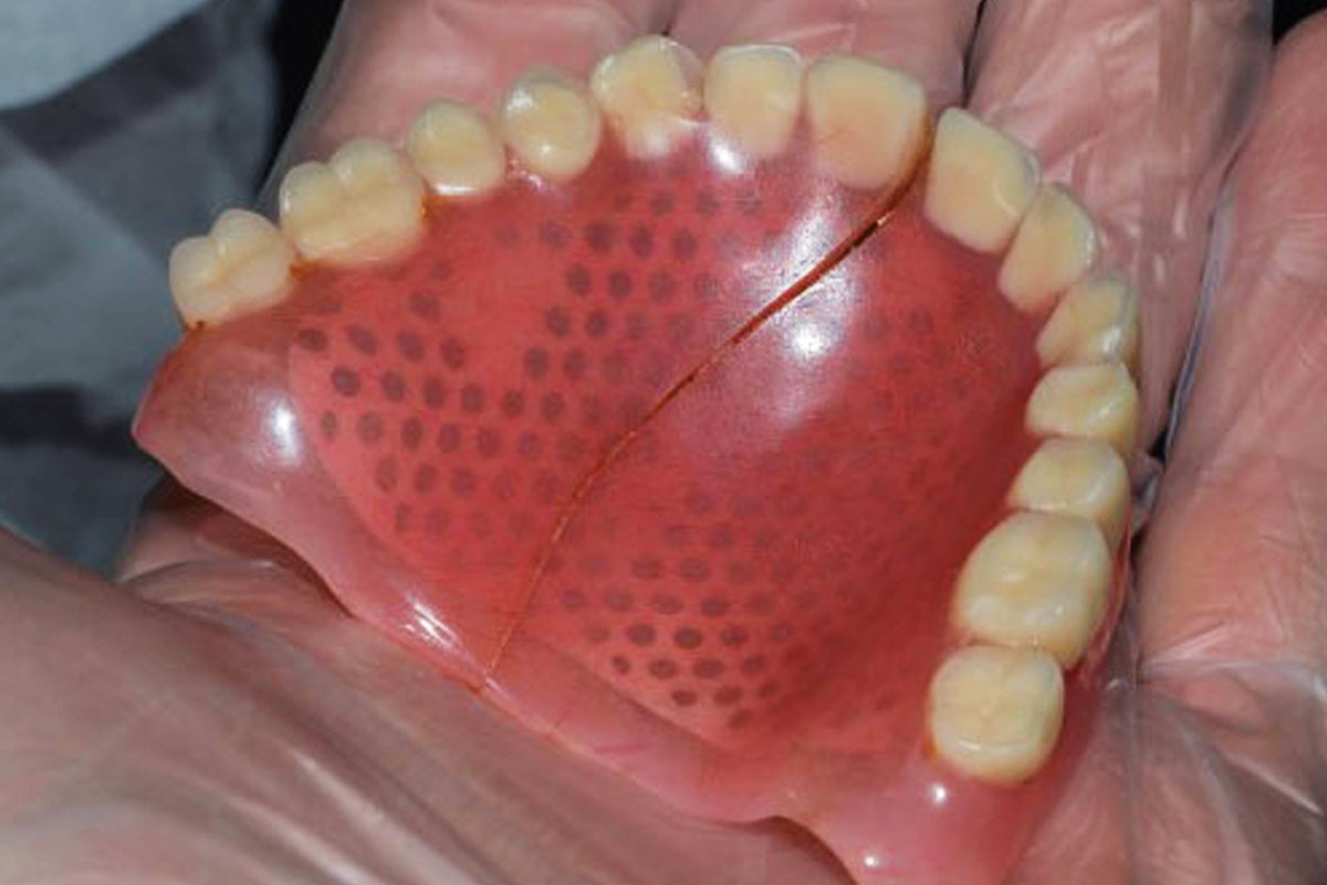 Denture repairs